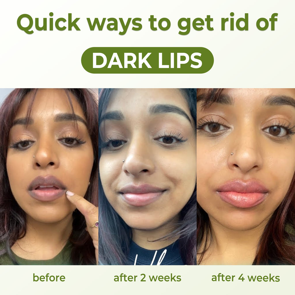 Belani Dark Lip Cream, Lips Balm For Dark Lip For Women & Men, Lip Wrinkle Repair, Lip Moisturizer For Very Dry Lips & Cracked, Remove Fordyce Lip Acne & Fordyce Spot 1.01 Fl Oz