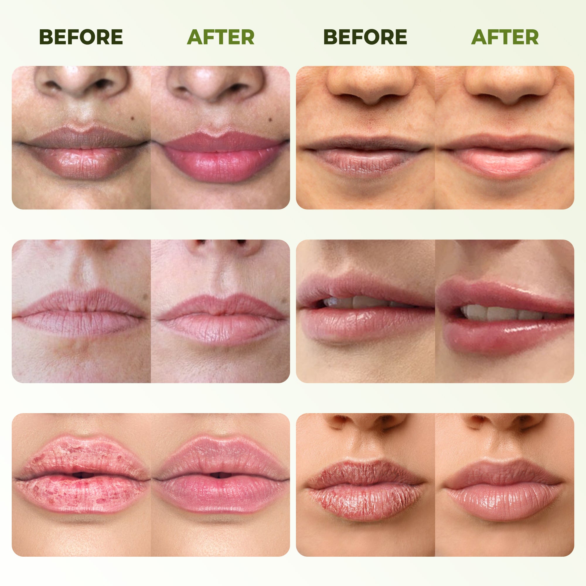 Belani Dark Lip Cream, Lips Balm For Dark Lip For Women & Men, Lip Wrinkle Repair, Lip Moisturizer For Very Dry Lips & Cracked, Remove Fordyce Lip Acne & Fordyce Spot 1.01 Fl Oz