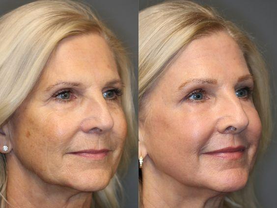 Belani Harumi Serum – Anti-Aging Serum For Face, Reduces Dark Spots & Wrinkles, Hydrating & Moisturizing Formula for a Youthful Glow with HA & Niacinamide (1.01 Fl. Oz)